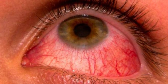 Aumentan los casos de conjuntivitis en Yucatán